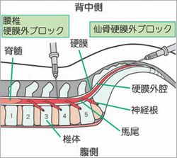 腰椎硬膜外 仙骨硬膜外 ブロック注射